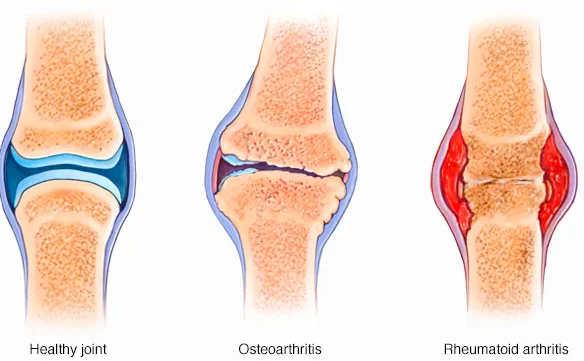 ds01122_ds00020_im03689_mcdc7_arthritis_typesthu_jpg